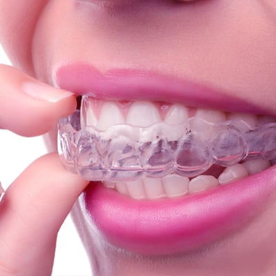 Invisalign for Adults